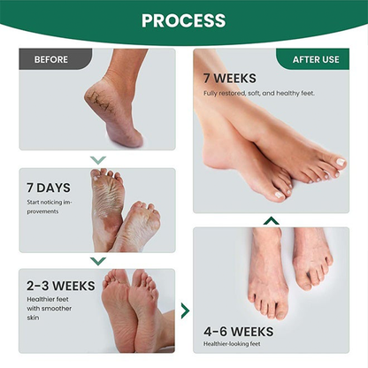 Feet Callus Remover Spray – Rough Skin Softening & Smoothing Foot Care